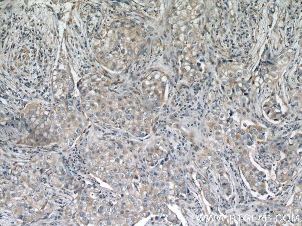 Immunohistochemistry (IHC) staining of human breast cancer tissue using PI3 Kinase p110 Alpha Polyclonal antibody (21890-1-AP)