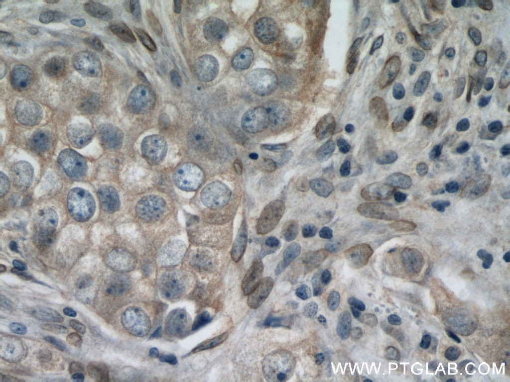 Immunohistochemistry (IHC) staining of human breast cancer tissue using PI3 Kinase p110 Alpha Polyclonal antibody (21890-1-AP)