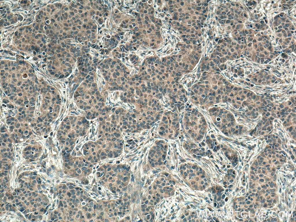 Immunohistochemistry (IHC) staining of human breast cancer tissue using PI3 Kinase p110 Alpha Monoclonal antibody (67071-1-Ig)