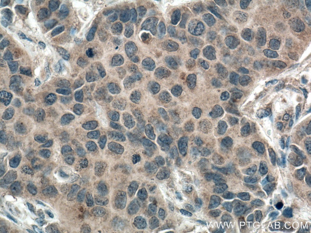 Immunohistochemistry (IHC) staining of human breast cancer tissue using PI3 Kinase p110 Alpha Monoclonal antibody (67071-1-Ig)