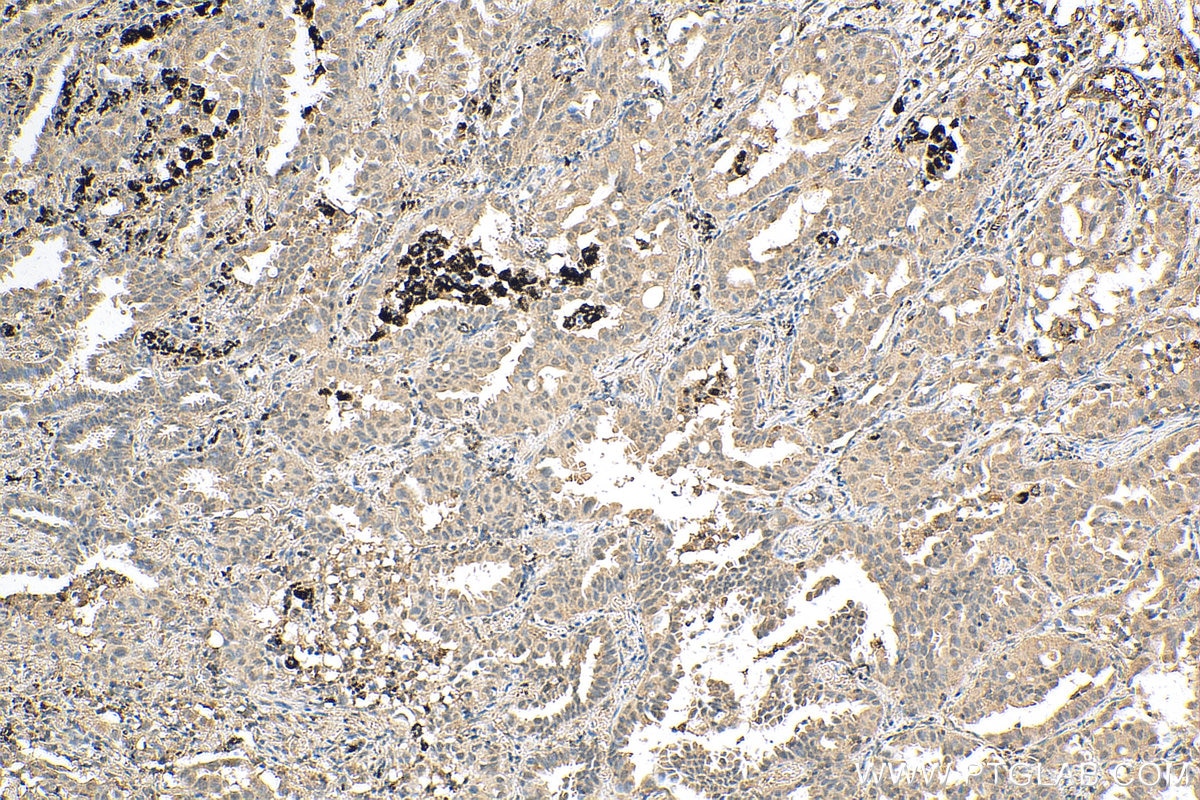 Immunohistochemistry (IHC) staining of human lung cancer tissue using PI3 Kinase p110 Beta Polyclonal antibody (20584-1-AP)