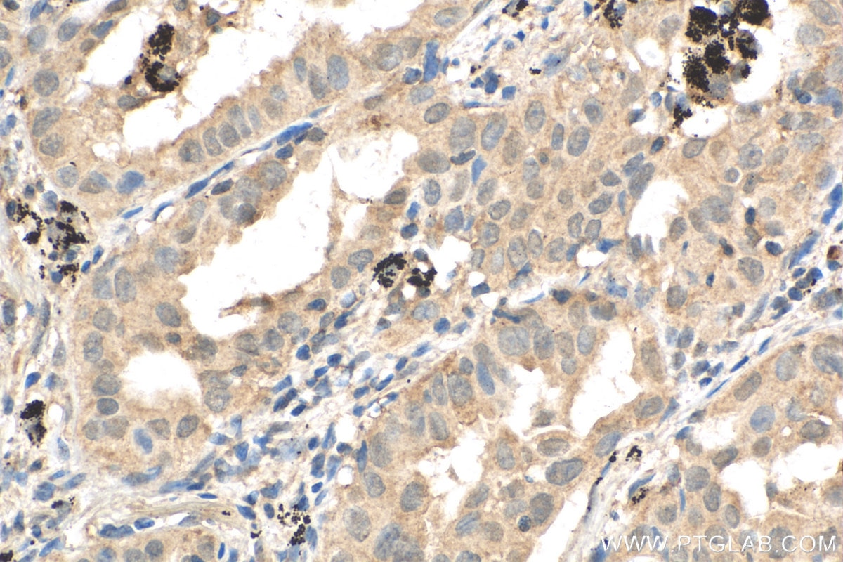 Immunohistochemistry (IHC) staining of human lung cancer tissue using PI3 Kinase p110 Beta Polyclonal antibody (20584-1-AP)
