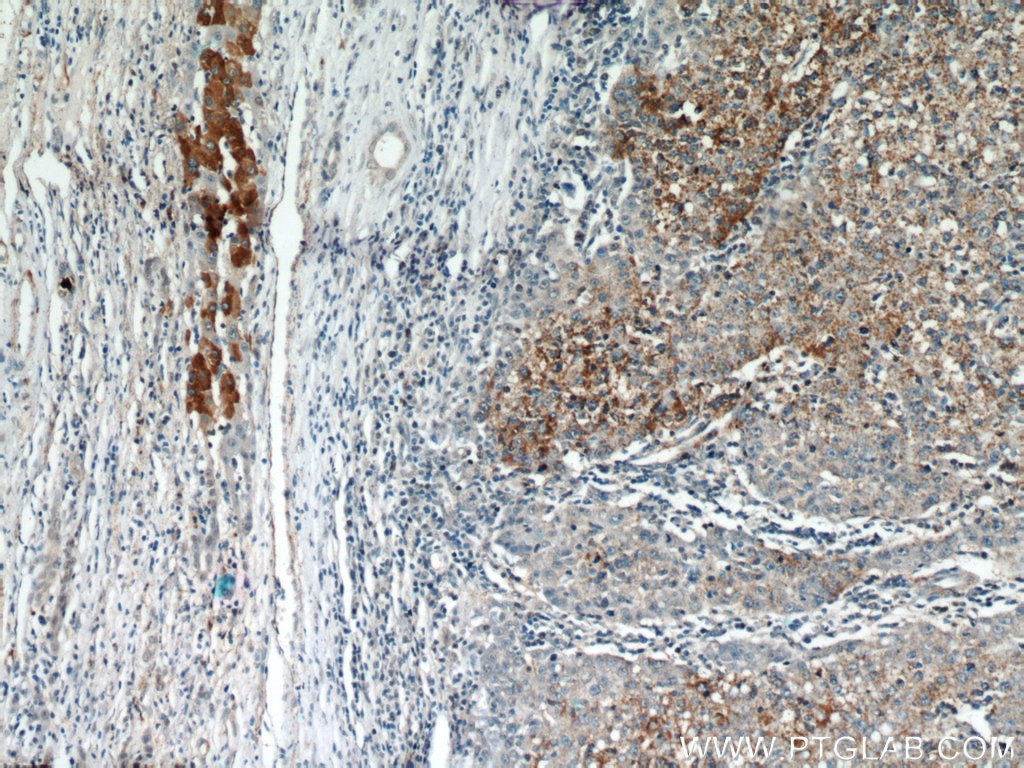 Immunohistochemistry (IHC) staining of human liver cancer tissue using PI3 Kinase p110 Beta Polyclonal antibody (21739-1-AP)