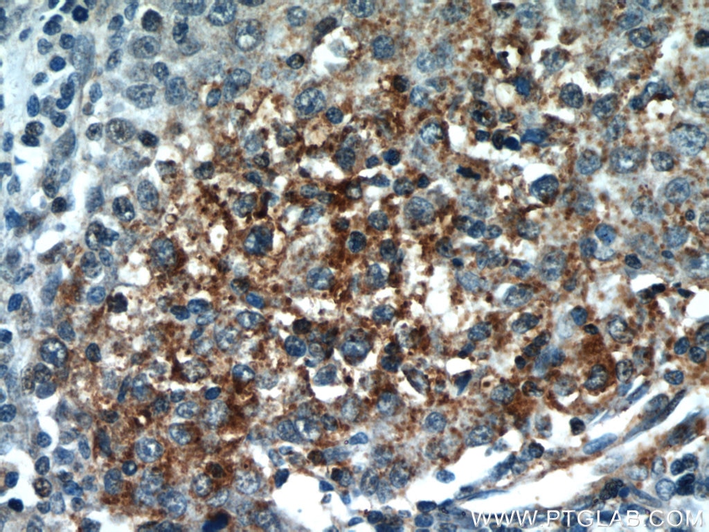 Immunohistochemistry (IHC) staining of human liver cancer tissue using PI3 Kinase p110 Beta Polyclonal antibody (21739-1-AP)