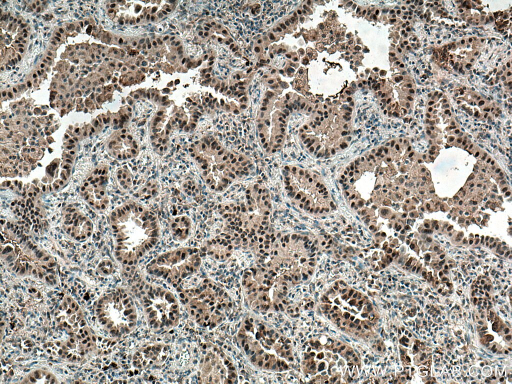 IHC staining of human lung cancer using 67121-1-Ig