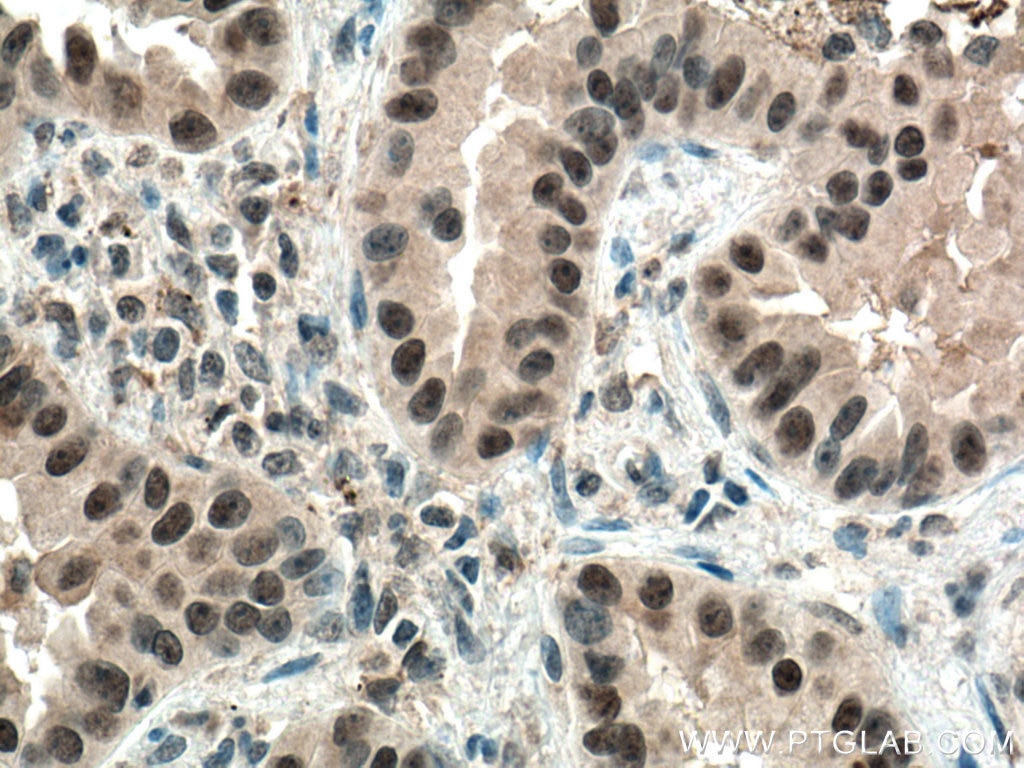 Immunohistochemistry (IHC) staining of human lung cancer tissue using PI3 Kinase p110 Beta Monoclonal antibody (67121-1-Ig)