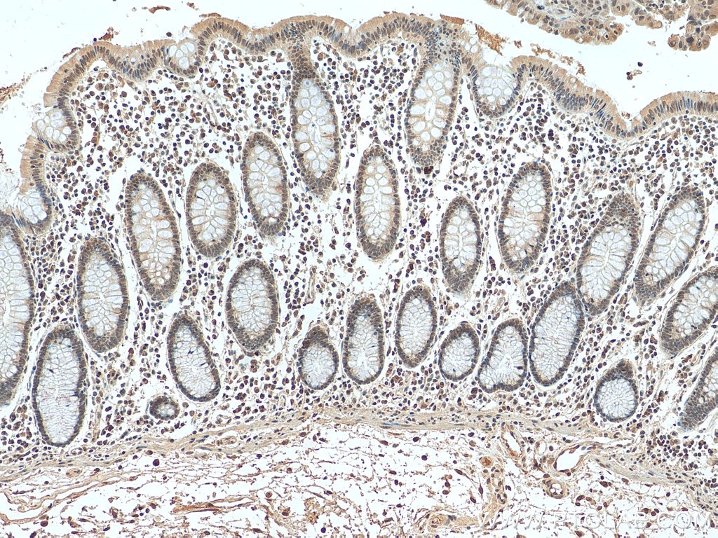 IHC staining of human colon cancer using 67121-1-Ig