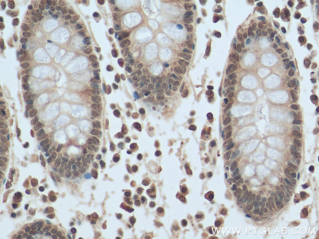 IHC staining of human colon cancer using 67121-1-Ig
