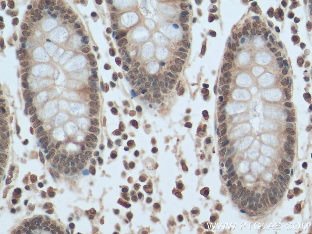 Immunohistochemistry (IHC) staining of human colon cancer tissue using PI3 Kinase p110 Beta Monoclonal antibody (67121-1-Ig)