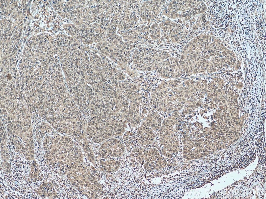 Immunohistochemistry (IHC) staining of human cervical cancer tissue using PI3 Kinase p110 Beta Monoclonal antibody (67121-1-Ig)