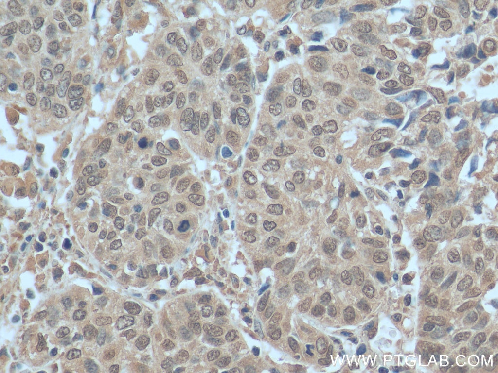 Immunohistochemistry (IHC) staining of human cervical cancer tissue using PI3 Kinase p110 Beta Monoclonal antibody (67121-1-Ig)