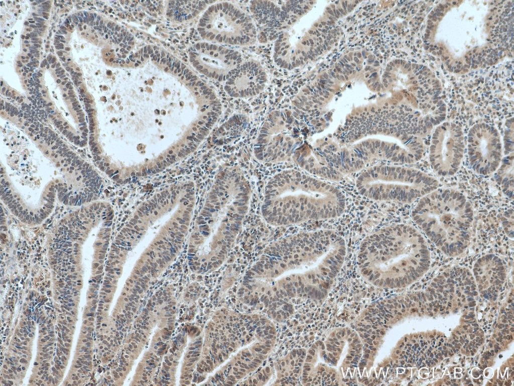 Immunohistochemistry (IHC) staining of human colon cancer tissue using PI3 Kinase p110 Beta Monoclonal antibody (67121-1-Ig)