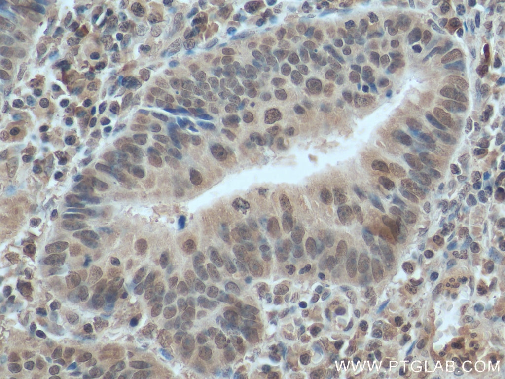 Immunohistochemistry (IHC) staining of human colon cancer tissue using PI3 Kinase p110 Beta Monoclonal antibody (67121-1-Ig)