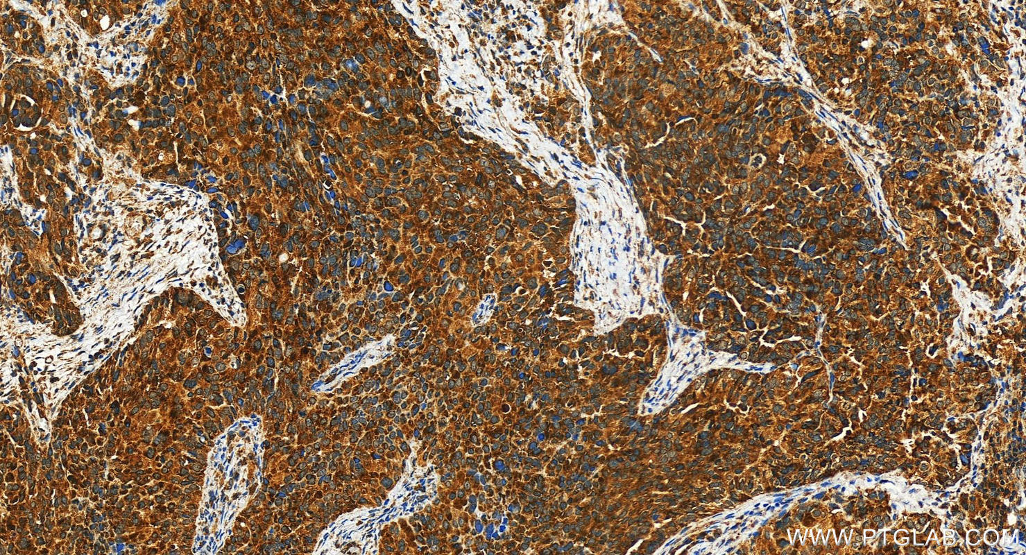 Immunohistochemistry (IHC) staining of human ovary cancer tissue using PIK3CG Polyclonal antibody (31229-1-AP)