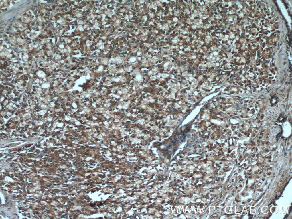 Immunohistochemistry (IHC) staining of human prostate cancer tissue using PI3 Kinase p85 Alpha Monoclonal antibody (60225-1-Ig)