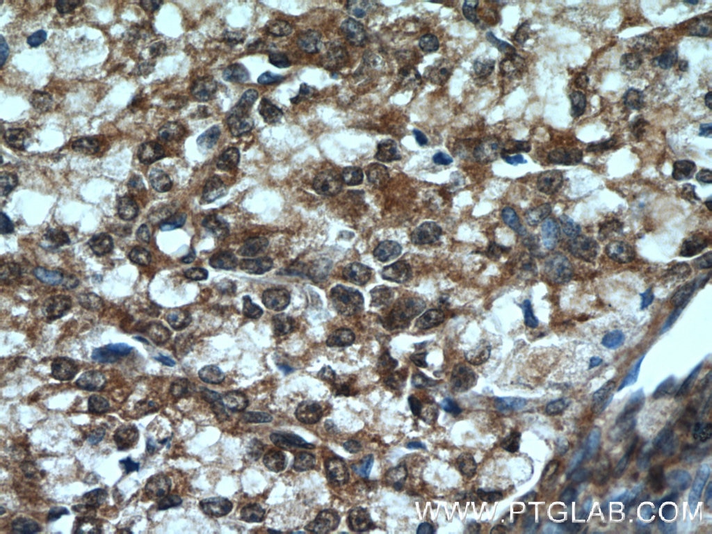 Immunohistochemistry (IHC) staining of human prostate cancer tissue using PI3 Kinase p85 Alpha Monoclonal antibody (60225-1-Ig)