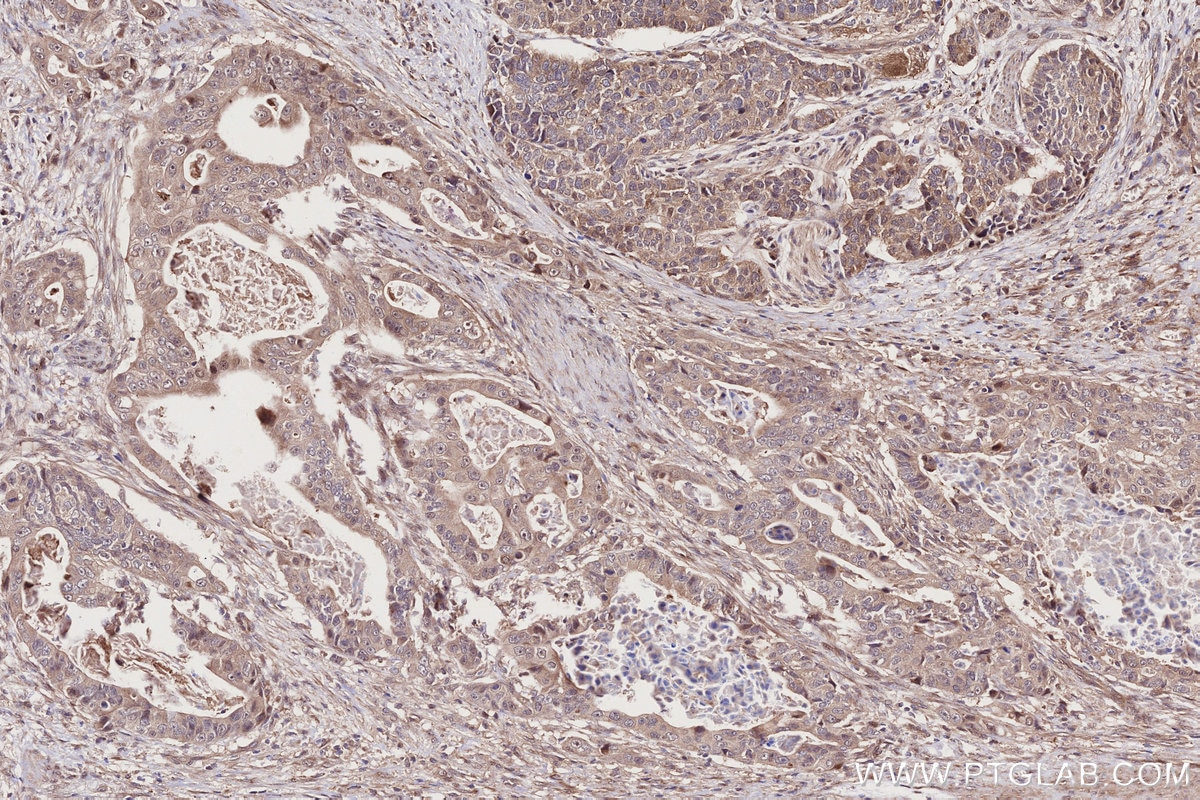 IHC staining of human stomach cancer using 27035-1-AP Immunohistochemistry (IHC) staining of human stomach cancer tissue using PI3 Kinase p55 Gamma Polyclonal antibody (27035-1-AP)