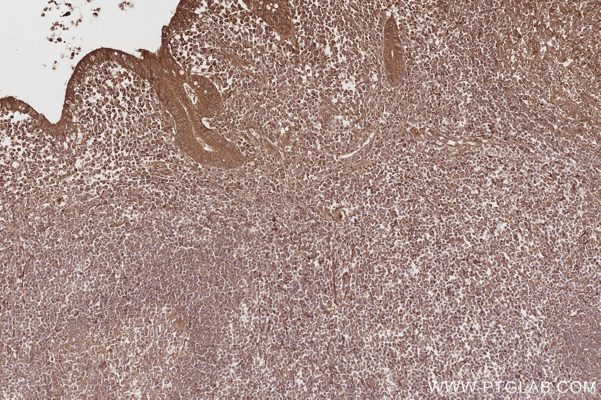 Immunohistochemistry (IHC) staining of human appendicitis tissue using VPS15 Polyclonal antibody (17894-1-AP)
