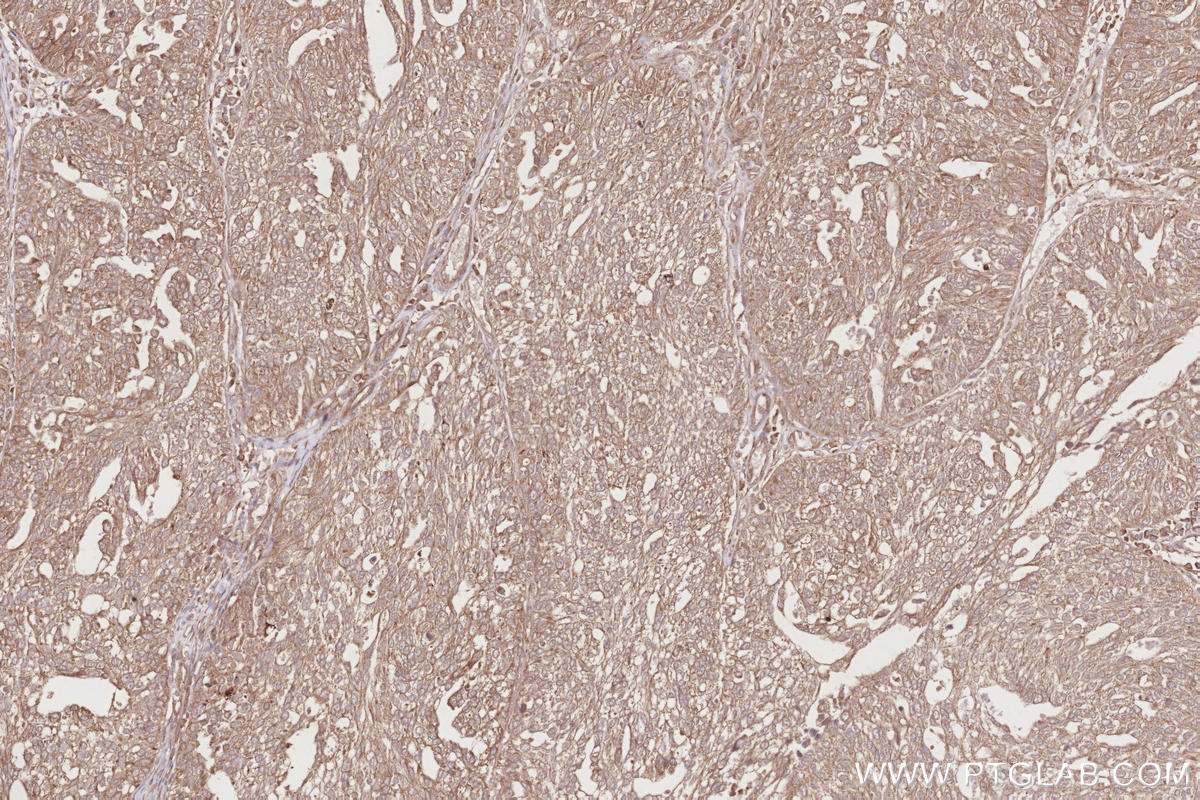 Immunohistochemistry (IHC) staining of human ovary cancer tissue using VPS15 Polyclonal antibody (17894-1-AP)
