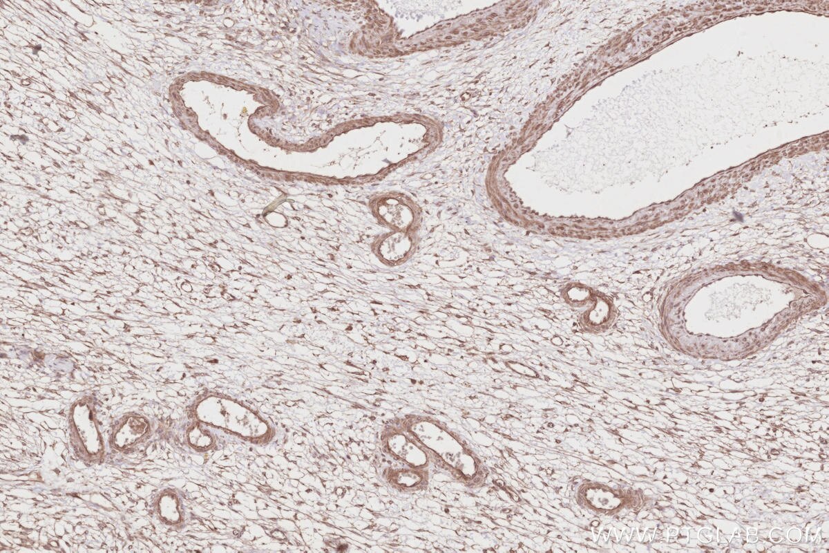 Immunohistochemistry (IHC) staining of human ovary cancer tissue using VPS15 Polyclonal antibody (17894-1-AP)
