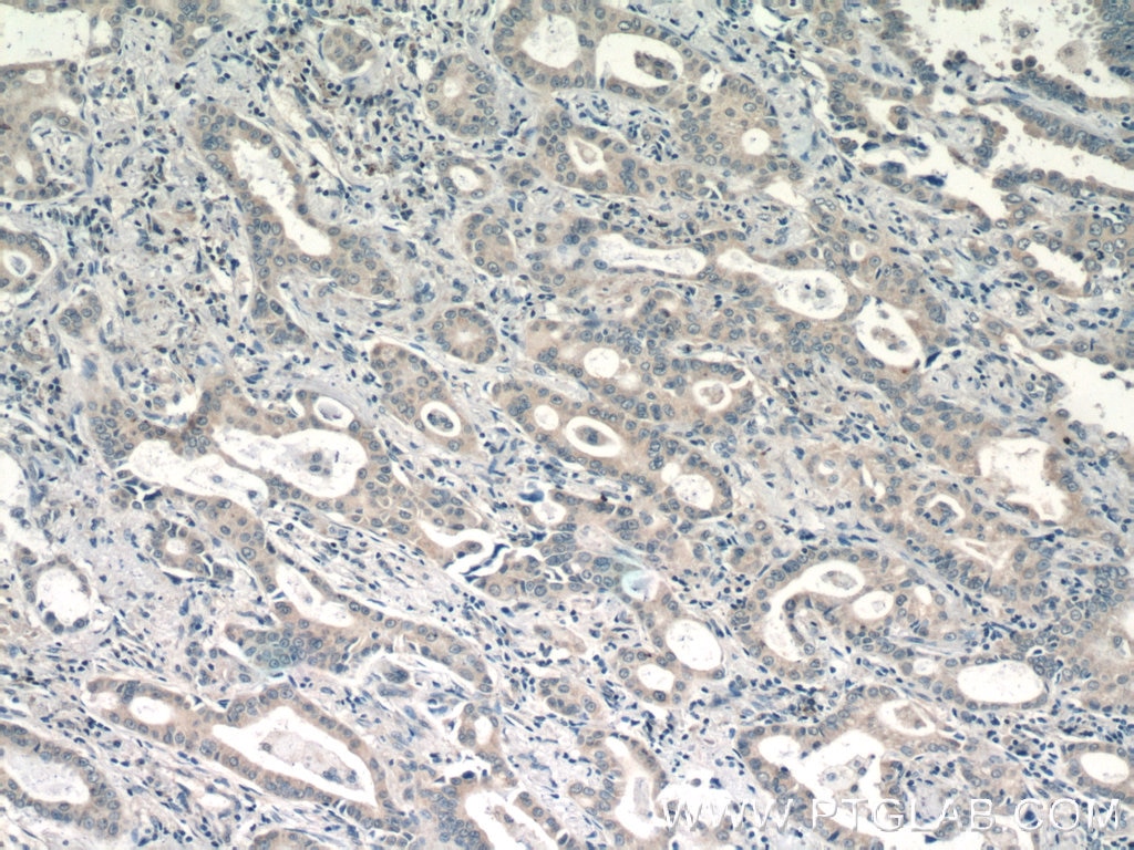 Immunohistochemistry (IHC) staining of human lung cancer tissue using PI3K p101 Polyclonal antibody (13329-1-AP)