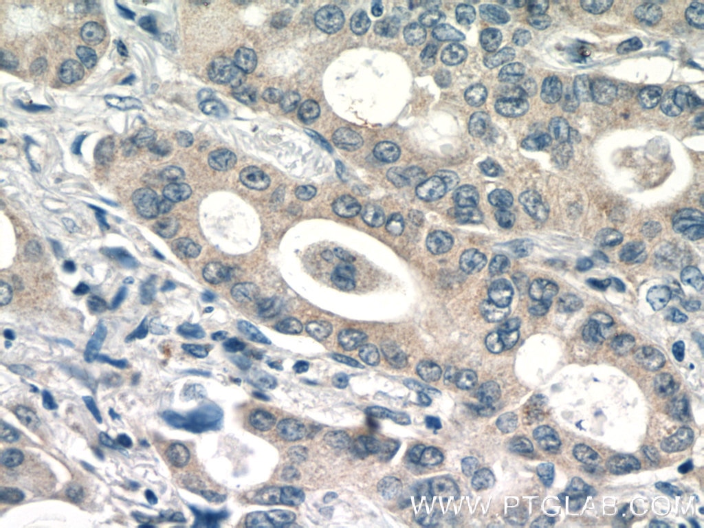 Immunohistochemistry (IHC) staining of human lung cancer tissue using PI3K p101 Polyclonal antibody (13329-1-AP)