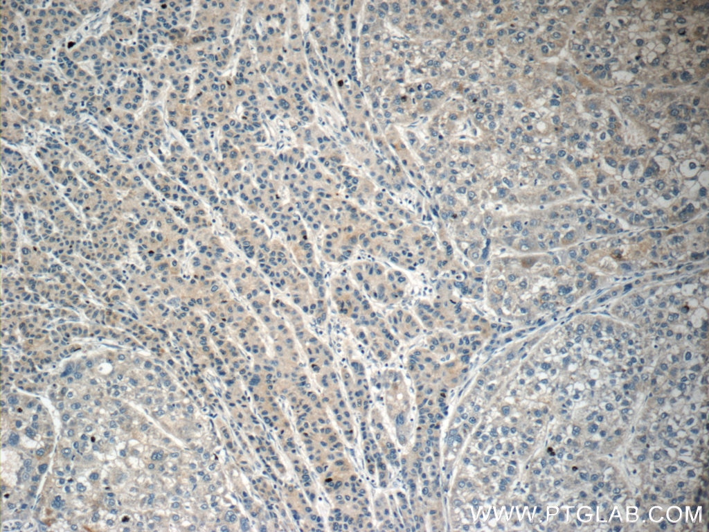 Immunohistochemistry (IHC) staining of human liver cancer tissue using PI3K p101 Polyclonal antibody (13329-1-AP)