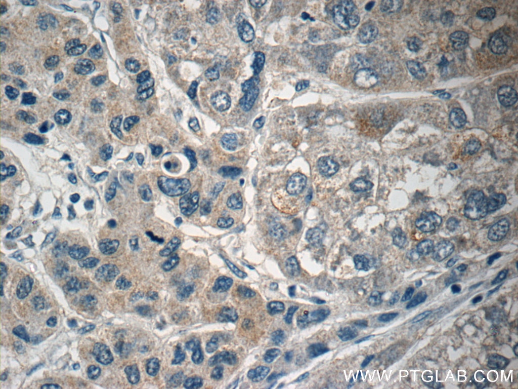 Immunohistochemistry (IHC) staining of human liver cancer tissue using PI3K p101 Polyclonal antibody (13329-1-AP)