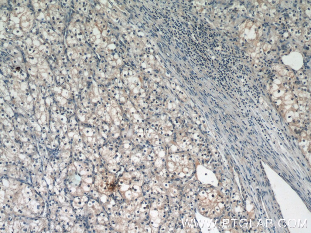 Immunohistochemistry (IHC) staining of human renal cell carcinoma tissue using PIN1 Polyclonal antibody (10495-1-AP)