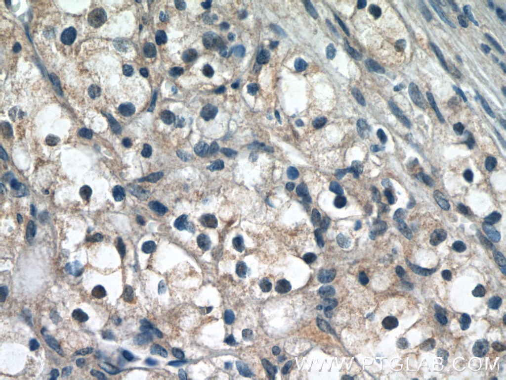 Immunohistochemistry (IHC) staining of human renal cell carcinoma tissue using PIN1 Polyclonal antibody (10495-1-AP)