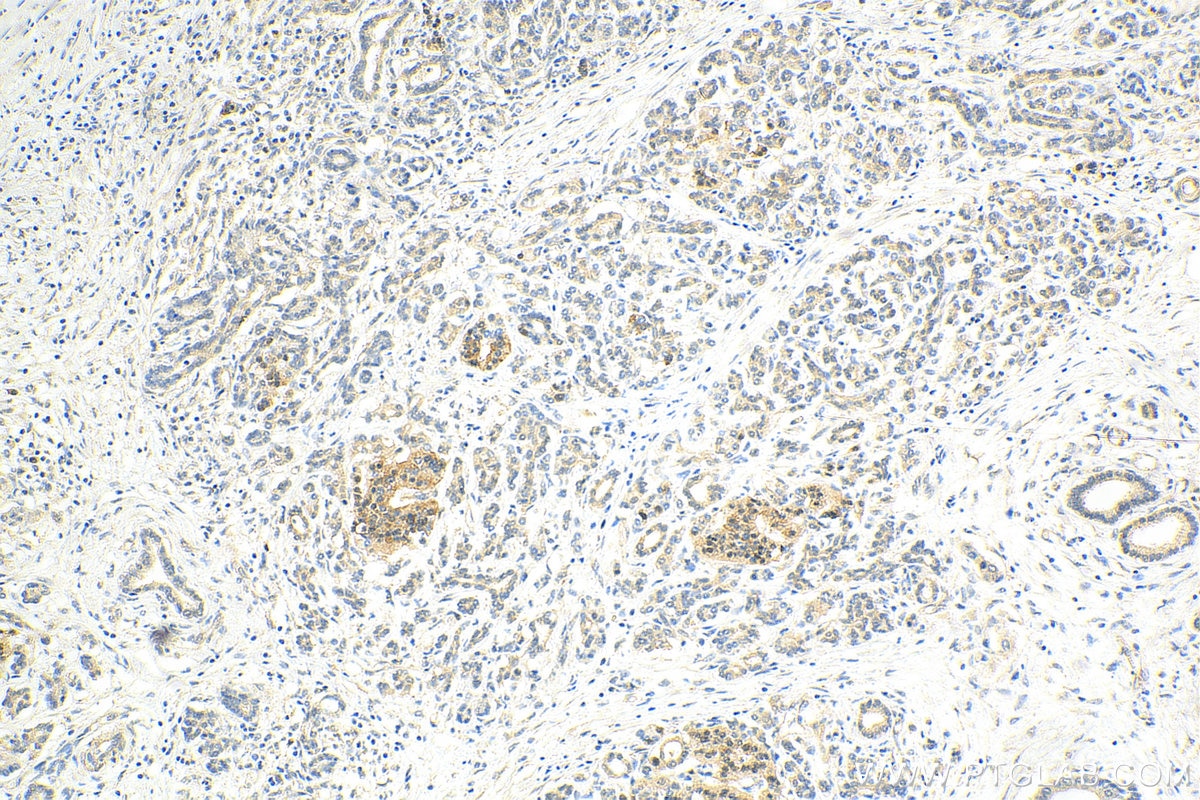 Immunohistochemistry (IHC) staining of human pancreas cancer tissue using PIN1 Polyclonal antibody (10495-1-AP)