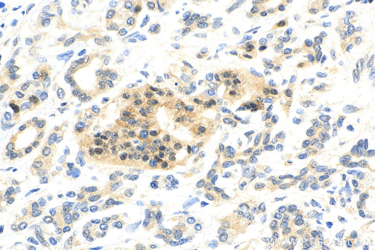 Immunohistochemistry (IHC) staining of human pancreas cancer tissue using PIN1 Polyclonal antibody (10495-1-AP)
