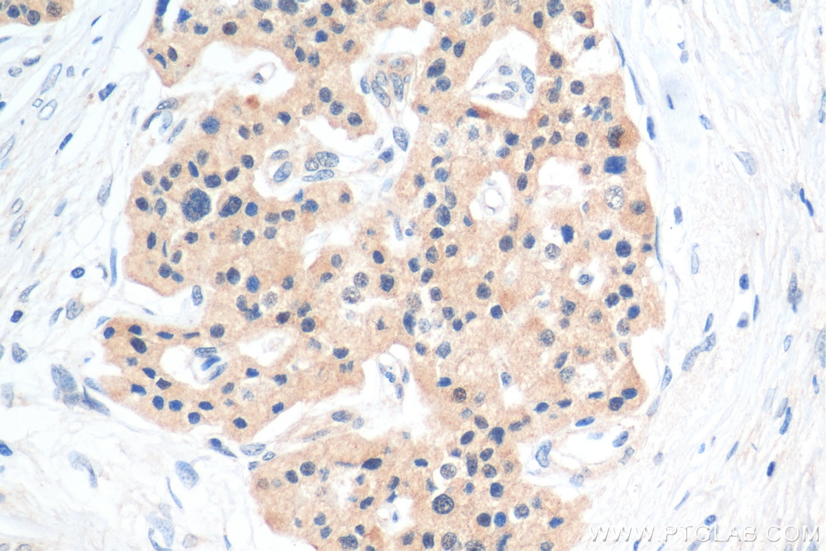 Immunohistochemistry (IHC) staining of human pancreas cancer tissue using PIN1 Polyclonal antibody (10495-1-AP)