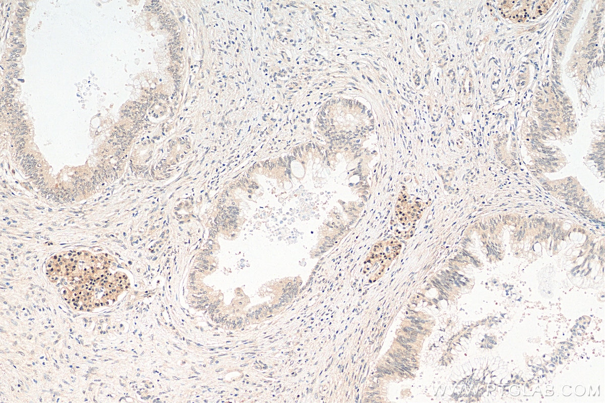 Immunohistochemistry (IHC) staining of human pancreas cancer tissue using PIN1 Recombinant antibody (81857-1-RR)