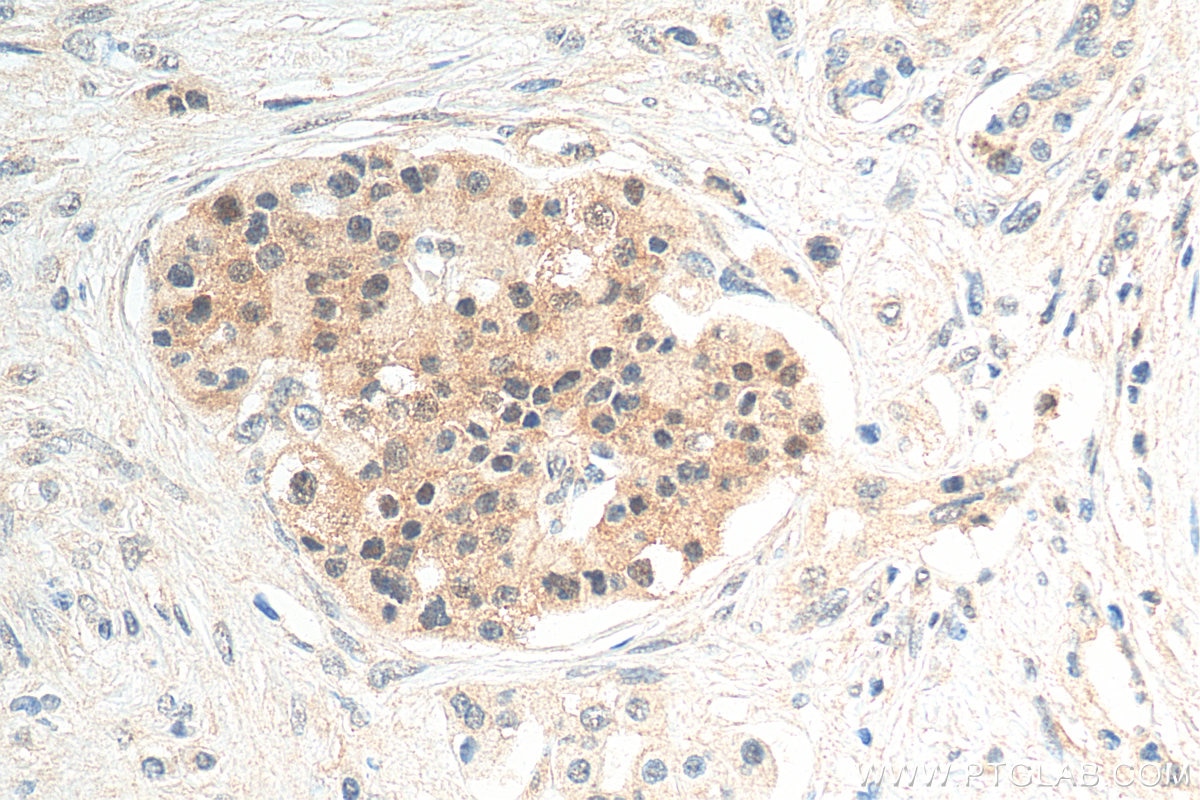 Immunohistochemistry (IHC) staining of human pancreas cancer tissue using PIN1 Recombinant antibody (81857-1-RR)