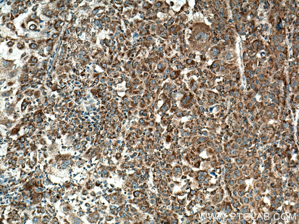 Immunohistochemistry (IHC) staining of human liver cancer tissue using PIN4 Polyclonal antibody (15789-1-AP)