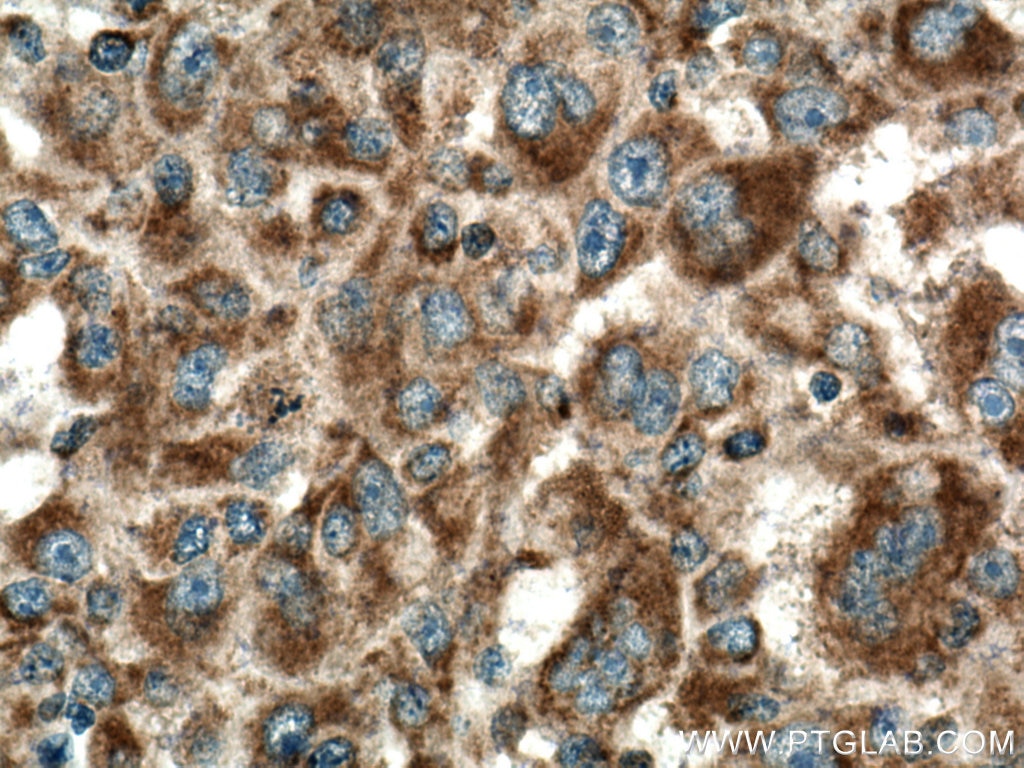 Immunohistochemistry (IHC) staining of human liver cancer tissue using PIN4 Polyclonal antibody (15789-1-AP)