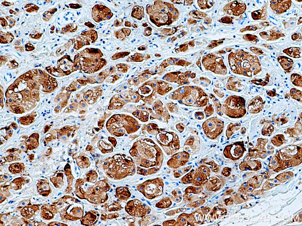 Immunohistochemistry (IHC) staining of human breast cancer tissue using GCDFP-15/PIP Polyclonal antibody (16068-1-AP)