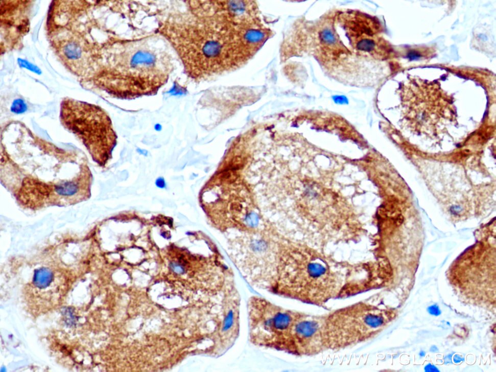 Immunohistochemistry (IHC) staining of human breast cancer tissue using GCDFP-15/PIP Polyclonal antibody (16068-1-AP)