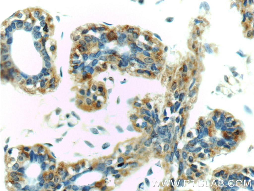 Immunohistochemistry (IHC) staining of human breast tissue using GCDFP-15/PIP Polyclonal antibody (16068-1-AP)