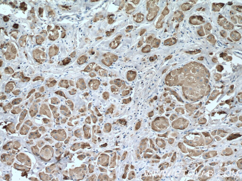 IHC staining of human breast cancer using 16068-1-AP