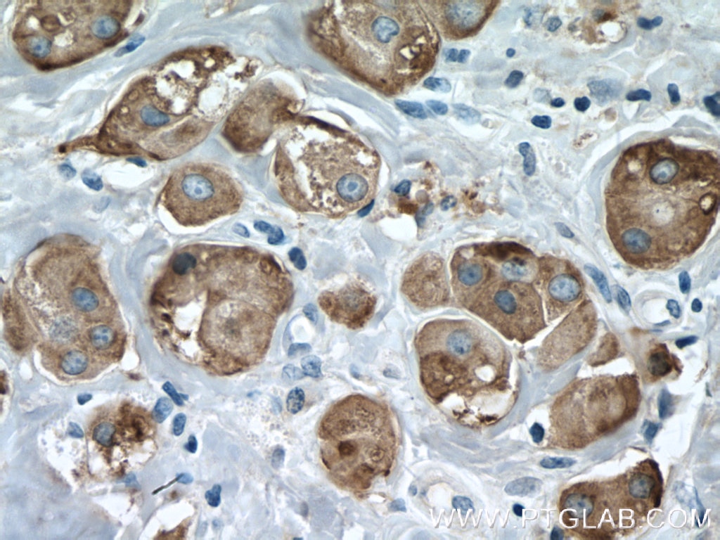 Immunohistochemistry (IHC) staining of human breast cancer tissue using GCDFP-15/PIP Polyclonal antibody (16068-1-AP)