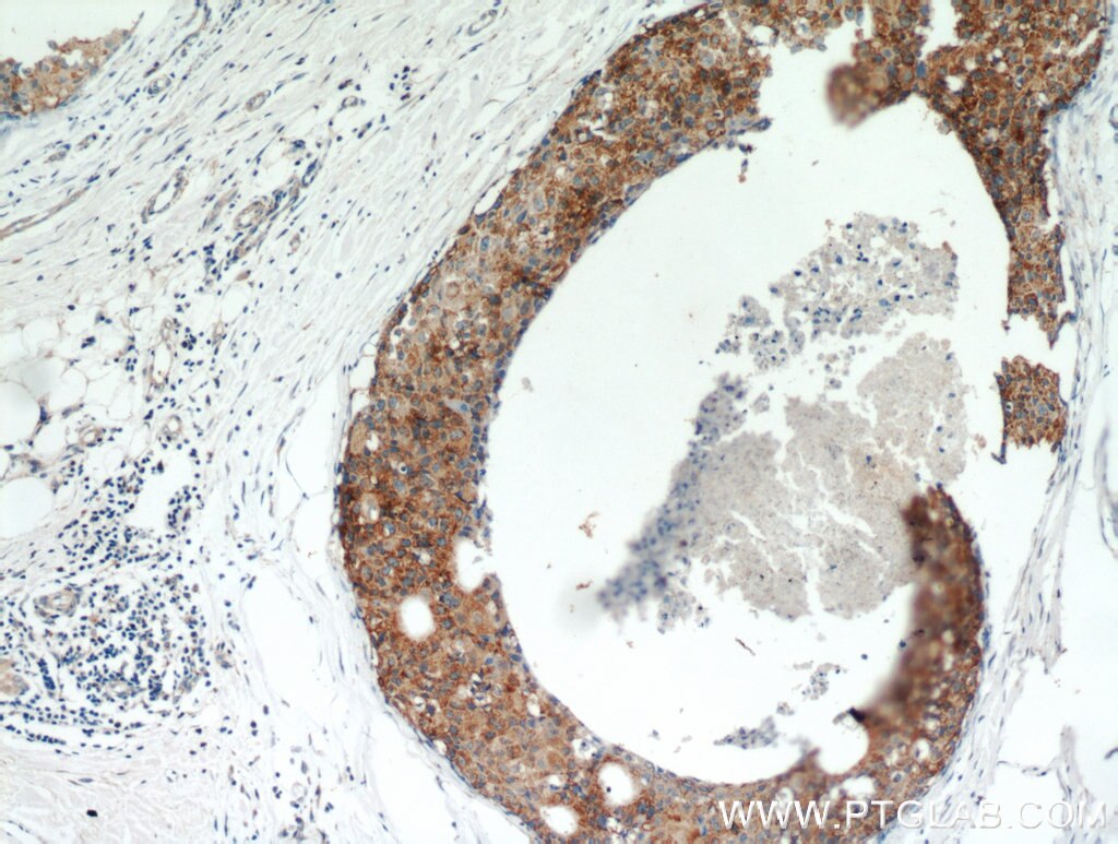 Immunohistochemistry (IHC) staining of human breast cancer tissue using GCDFP-15/PIP Polyclonal antibody (16068-1-AP)