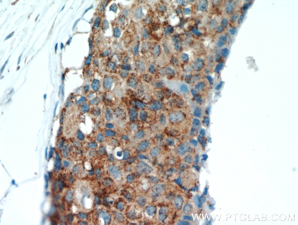 Immunohistochemistry (IHC) staining of human breast cancer tissue using GCDFP-15/PIP Polyclonal antibody (16068-1-AP)