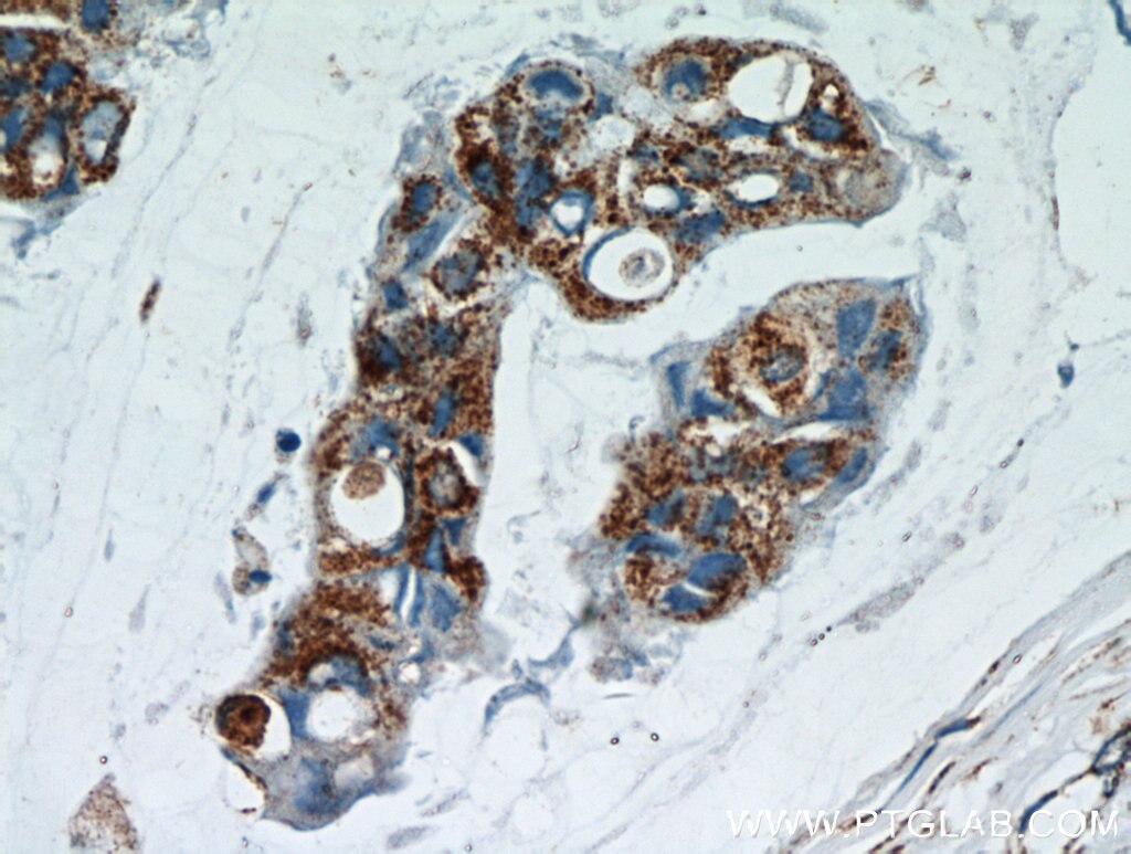 Immunohistochemistry (IHC) staining of human breast cancer tissue using GCDFP-15/PIP Polyclonal antibody (16068-1-AP)