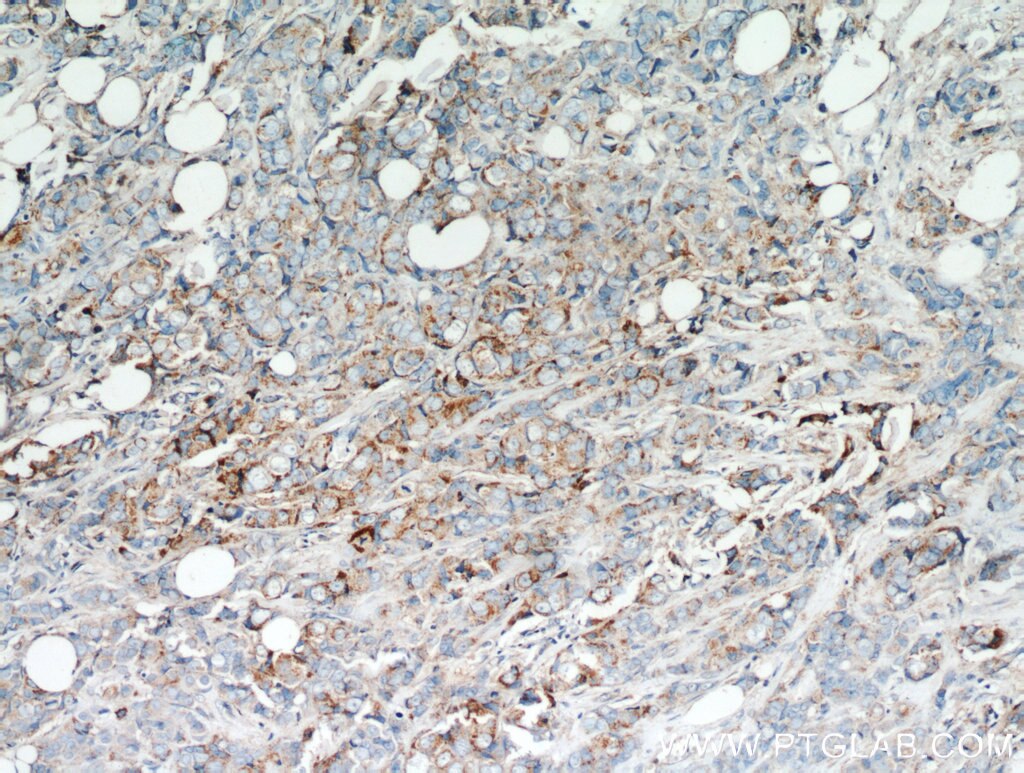 Immunohistochemistry (IHC) staining of human breast cancer tissue using GCDFP-15/PIP Polyclonal antibody (16068-1-AP)