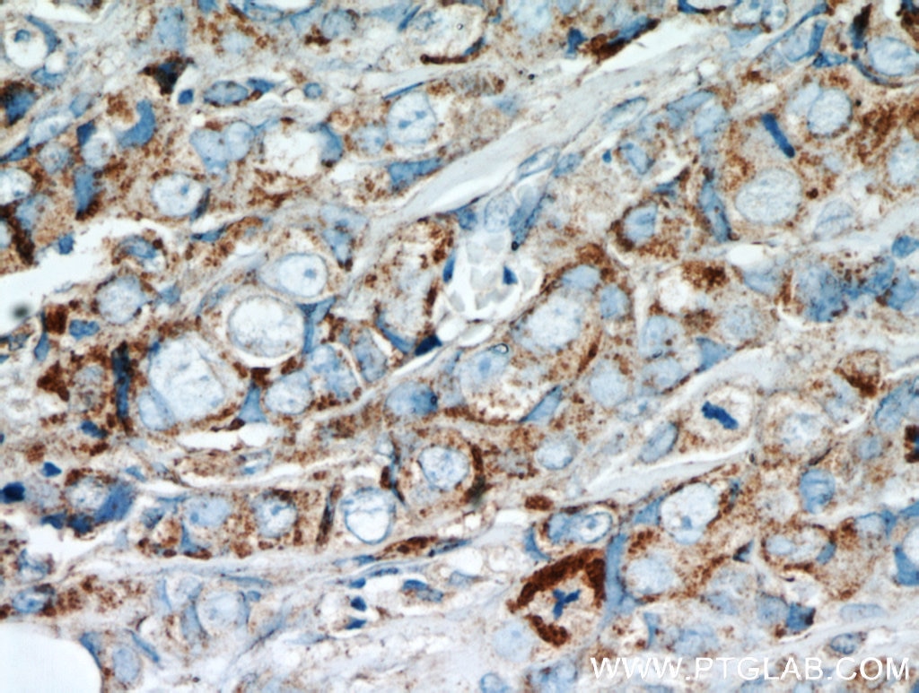 IHC staining of human breast cancer using 16068-1-AP