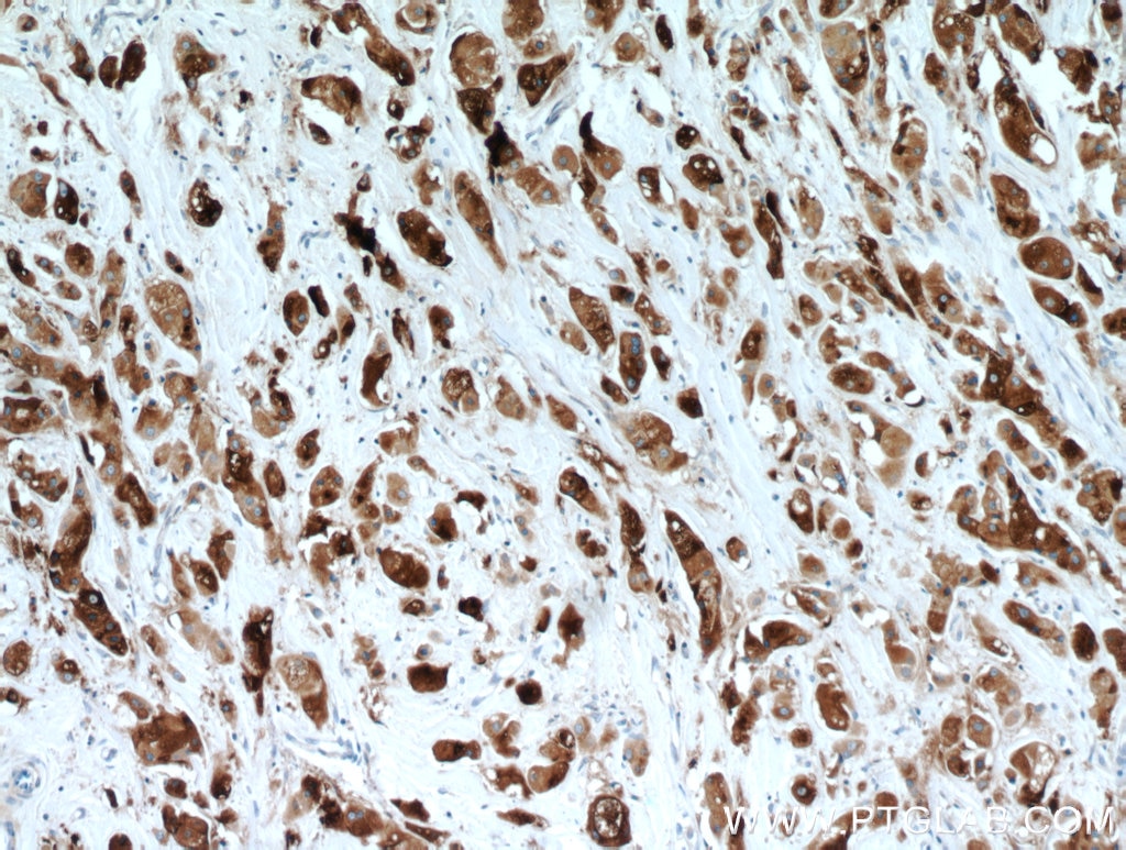 Immunohistochemistry (IHC) staining of human breast cancer tissue using GCDFP-15/PIP Polyclonal antibody (16068-1-AP)