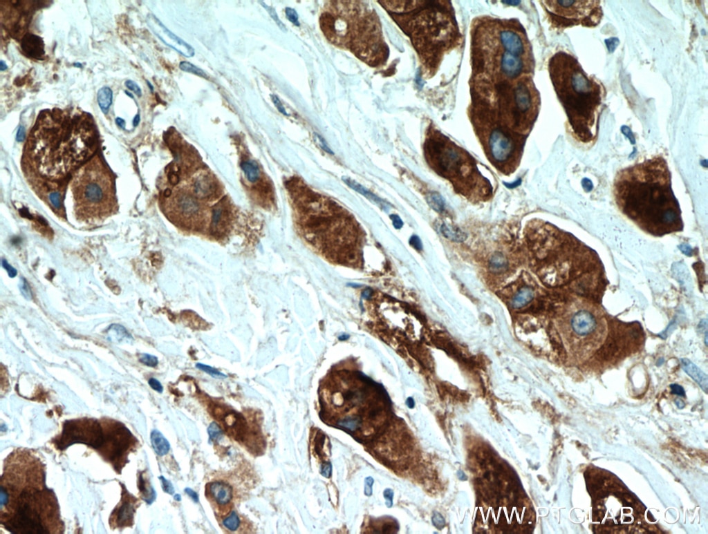 Immunohistochemistry (IHC) staining of human breast cancer tissue using GCDFP-15/PIP Polyclonal antibody (16068-1-AP)