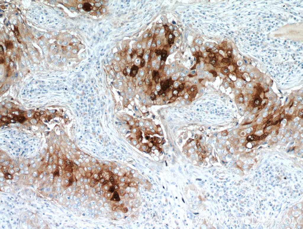 Immunohistochemistry (IHC) staining of human breast cancer tissue using GCDFP-15/PIP Polyclonal antibody (16068-1-AP)